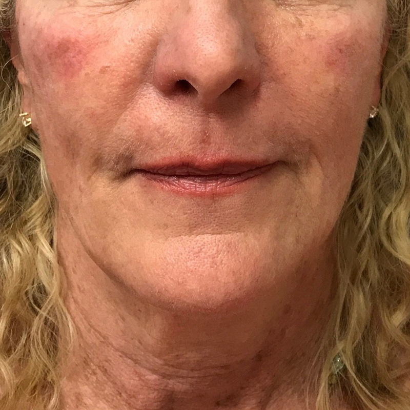 Cheek Filler Before & After Gallery - Patient 175530395 - Image 2