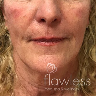 Cheek Filler Before & After Gallery - Patient 175530395 - Image 2