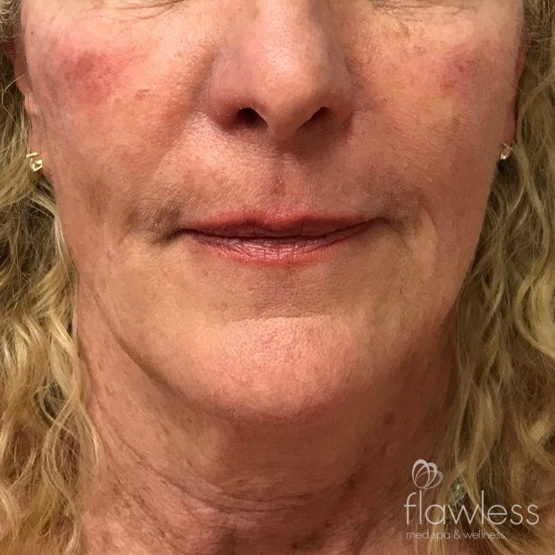 Cheek Filler Before & After Gallery - Patient 175530395 - Image 2