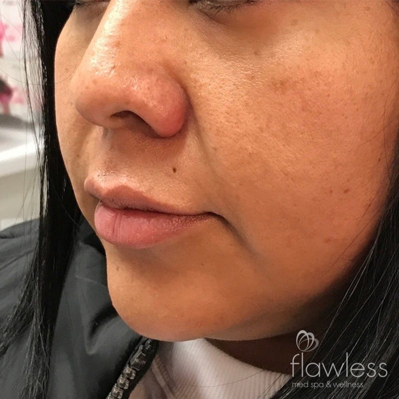 Lip Filler Before & After Gallery - Patient 175530396 - Image 1
