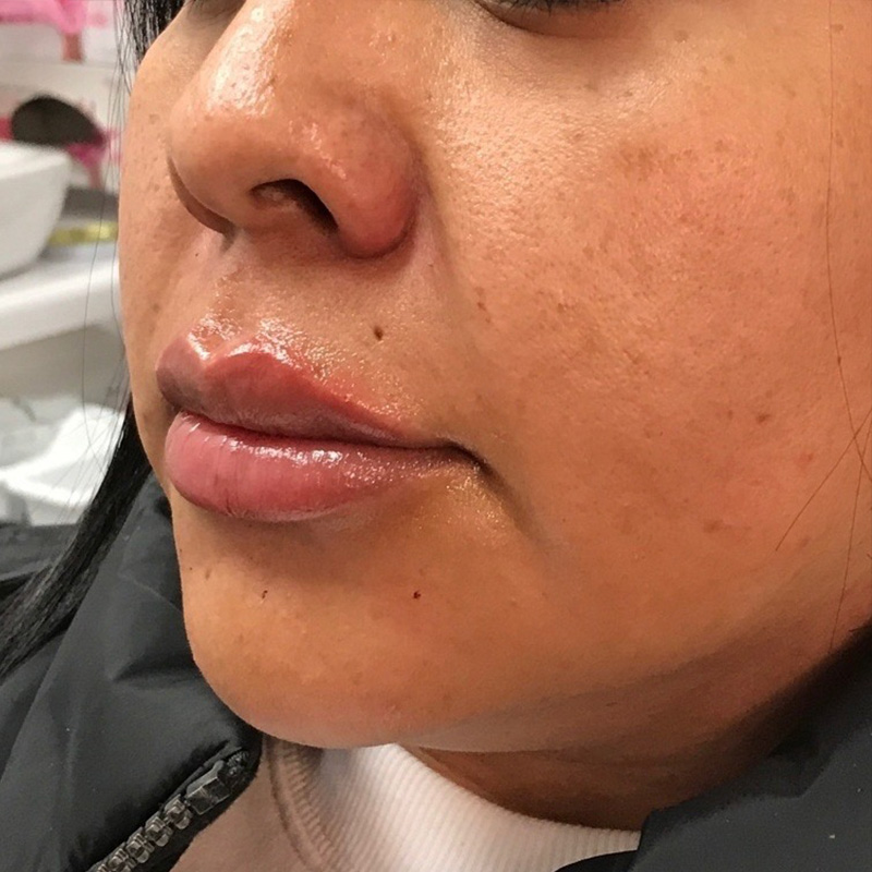 Lip Filler Before & After Gallery - Patient 175530396 - Image 2