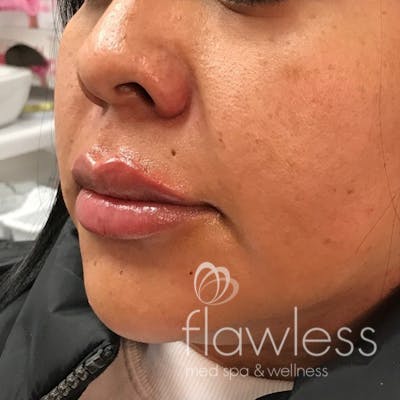 Lip Filler Before & After Gallery - Patient 175530396 - Image 2