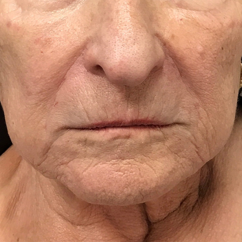 Lip Filler Before & After Gallery - Patient 175530398 - Image 1