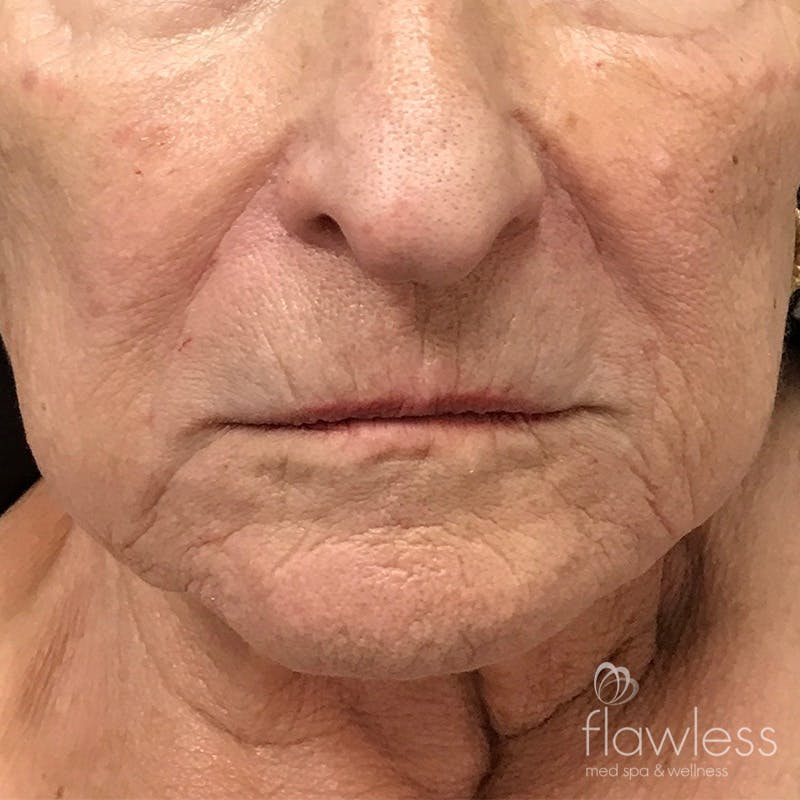 Lip Filler Before & After Gallery - Patient 175530398 - Image 1