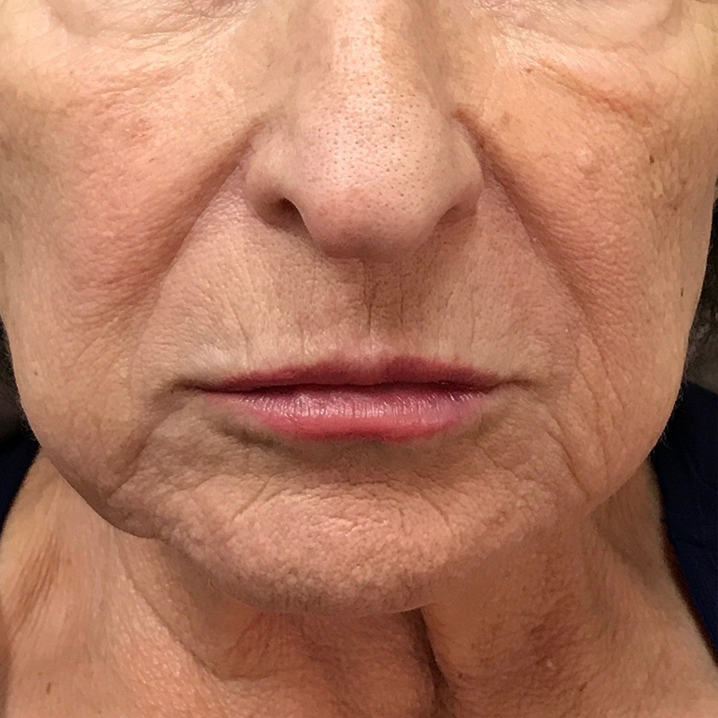 Lip Filler Before & After Gallery - Patient 175530398 - Image 2