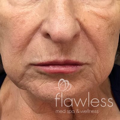 Lip Filler Before & After Gallery - Patient 175530398 - Image 2
