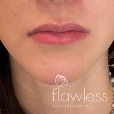 Lip Filler Before & After Gallery - Patient 175530410 - Image 1
