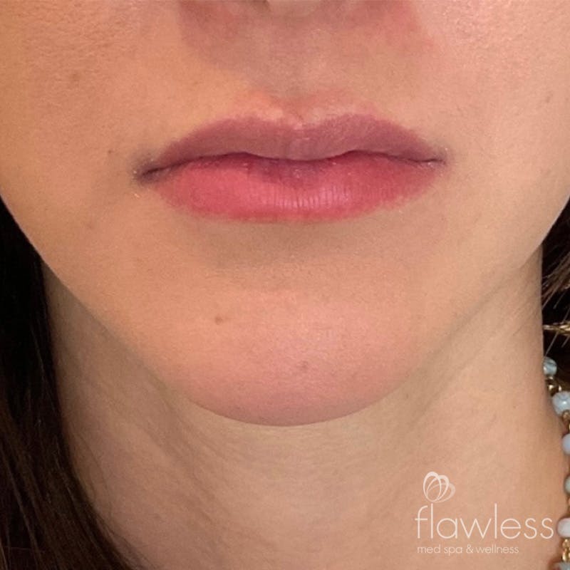 Lip Filler Before & After Gallery - Patient 175530410 - Image 1