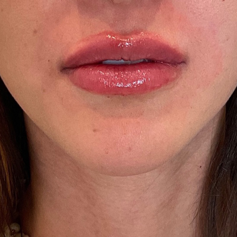 Lip Filler Before & After Gallery - Patient 175530410 - Image 2