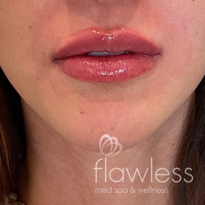 Lip Filler Before & After Gallery - Patient 175530410 - Image 2