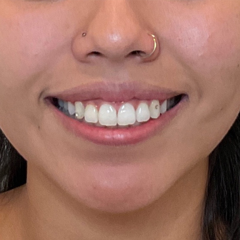 Lip Filler Before & After Gallery - Patient 175530406 - Image 1