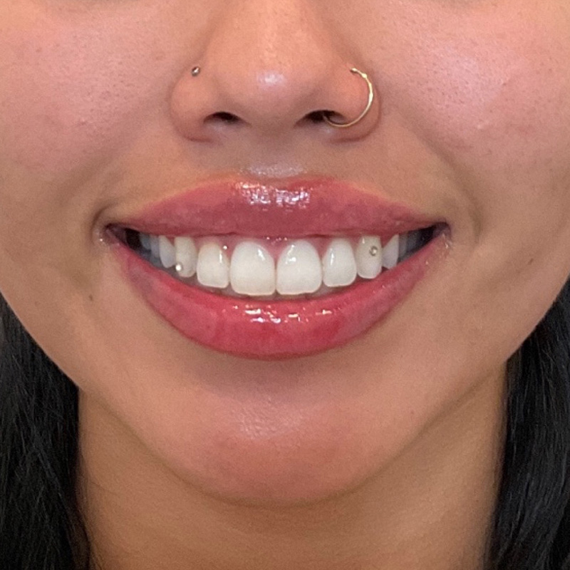 Lip Filler Before & After Gallery - Patient 175530406 - Image 2