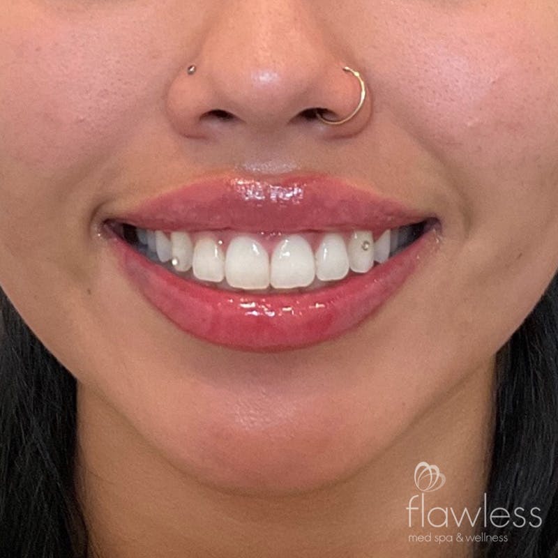 Lip Filler Before & After Gallery - Patient 175530406 - Image 2