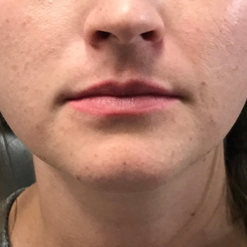 Lip Filler Before & After Gallery - Patient 175530408 - Image 1