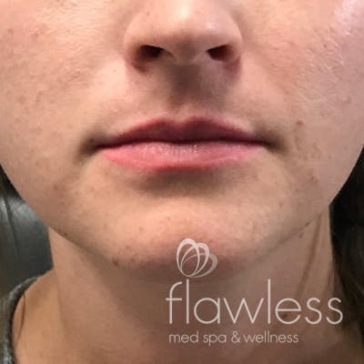Lip Filler Before & After Gallery - Patient 175530408 - Image 1