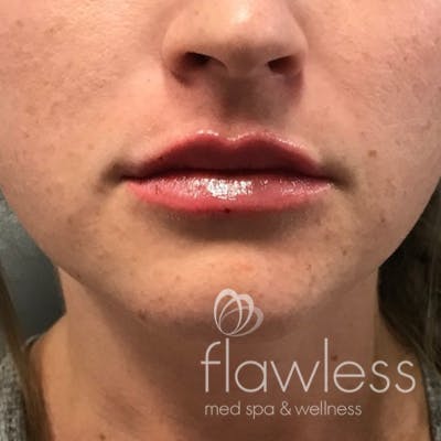 Lip Filler Before & After Gallery - Patient 175530408 - Image 2