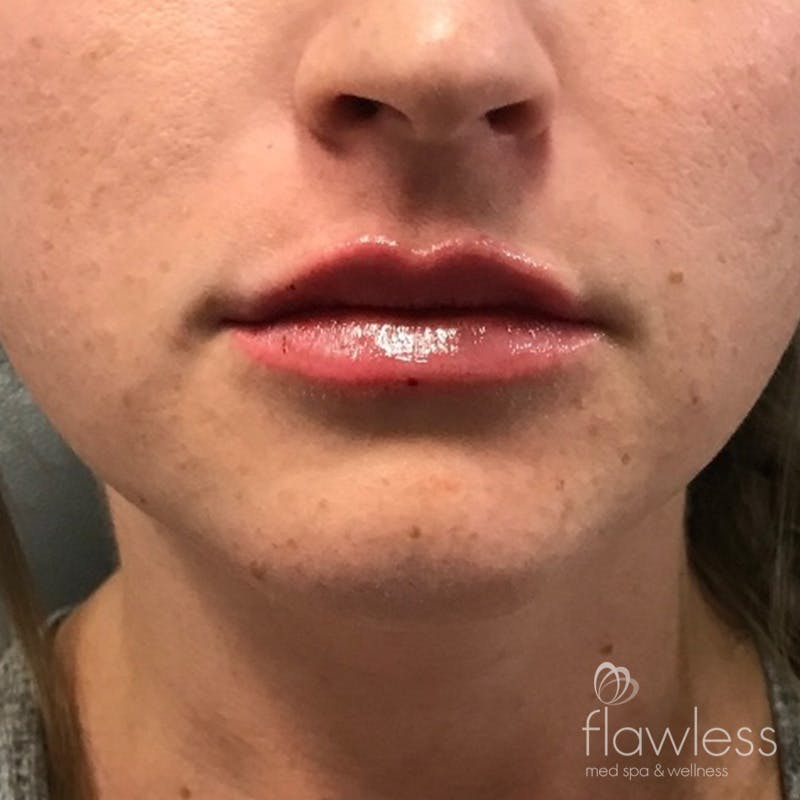 Lip Filler Before & After Gallery - Patient 175530408 - Image 2