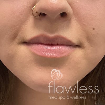Lip Filler Before & After Gallery - Patient 175530409 - Image 1