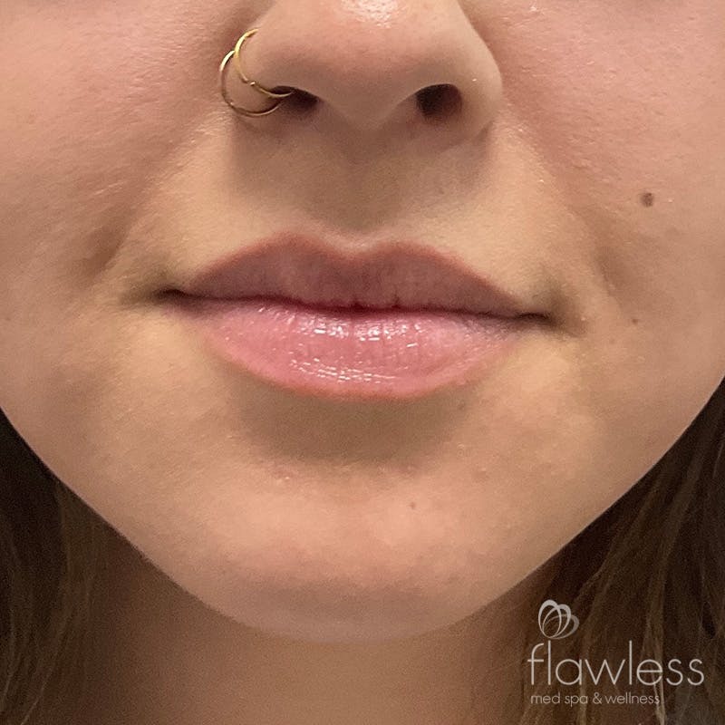 Lip Filler Before & After Gallery - Patient 175530409 - Image 1