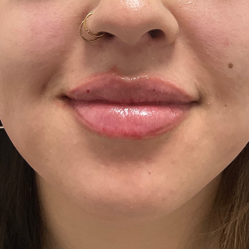 Lip Filler Before & After Gallery - Patient 175530409 - Image 2