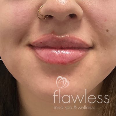 Lip Filler Before & After Gallery - Patient 175530409 - Image 2