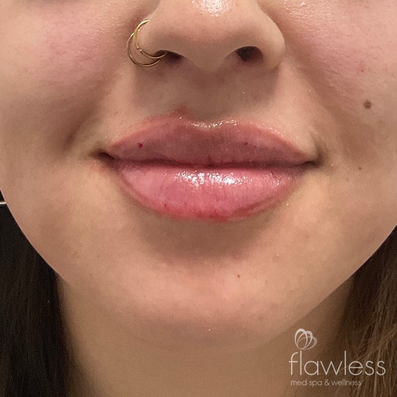 Lip Filler Before & After Gallery - Patient 175530409 - Image 2