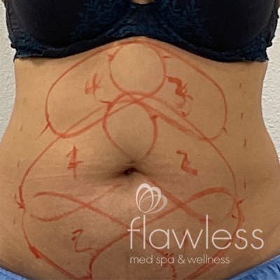 Coolsculpting Before & After Gallery - Patient 176657352 - Image 1