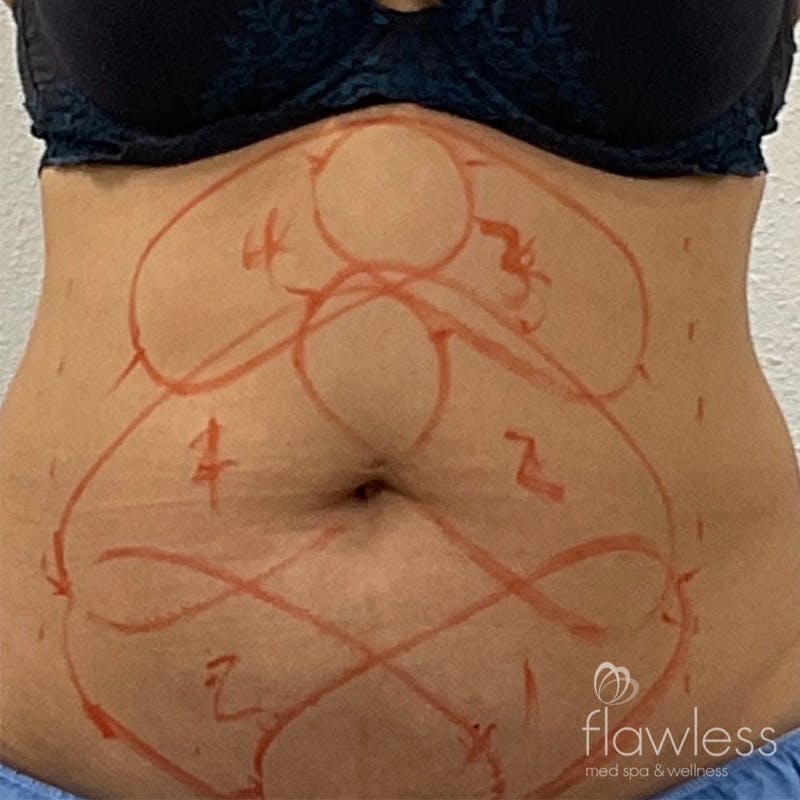 Coolsculpting Before & After Gallery - Patient 176657352 - Image 1