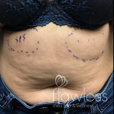 Coolsculpting Before & After Gallery - Patient 176657352 - Image 2