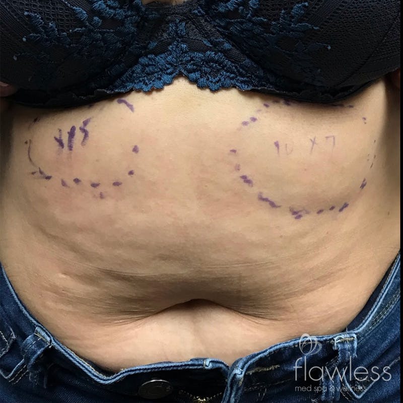 Coolsculpting Before & After Gallery - Patient 176657352 - Image 2