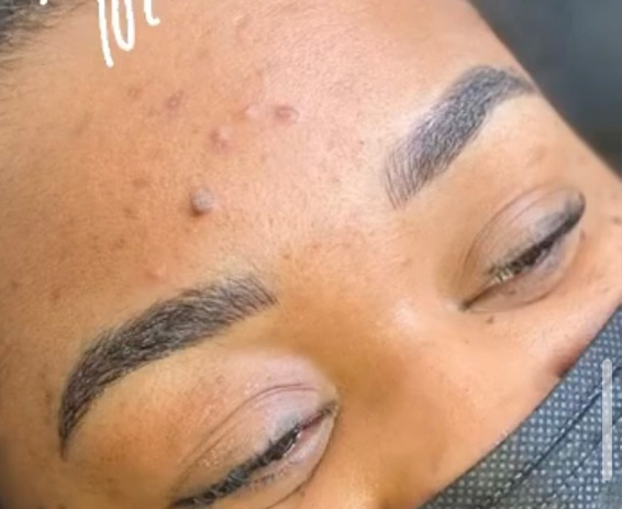 Permanent Make-up Before & After Gallery - Patient 176657368 - Image 2