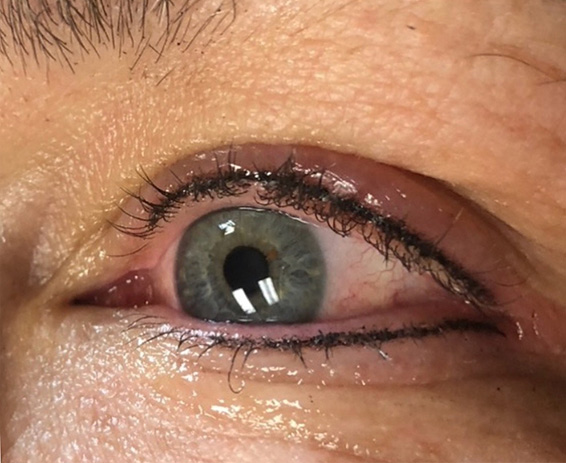 Permanent Make-up Before & After Gallery - Patient 176657375 - Image 2