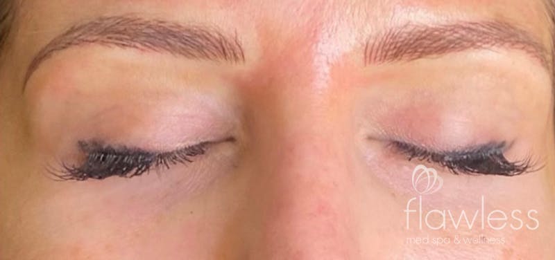 Permanent Make-up Before & After Gallery - Patient 176657376 - Image 2