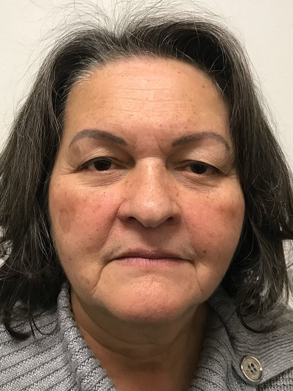 Pico Laser Skin Rejuvenation Before & After Gallery - Patient 176657394 - Image 1