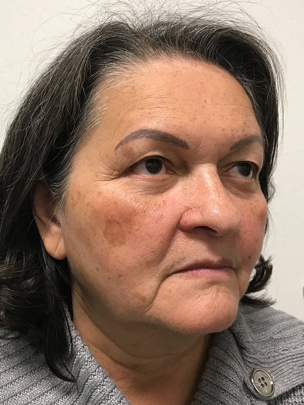 Pico Laser Skin Rejuvenation Before & After Gallery - Patient 176657394 - Image 3
