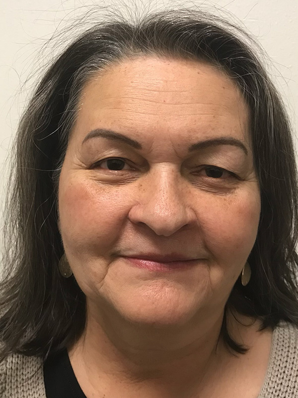 Pico Laser Skin Rejuvenation Before & After Gallery - Patient 176657394 - Image 2