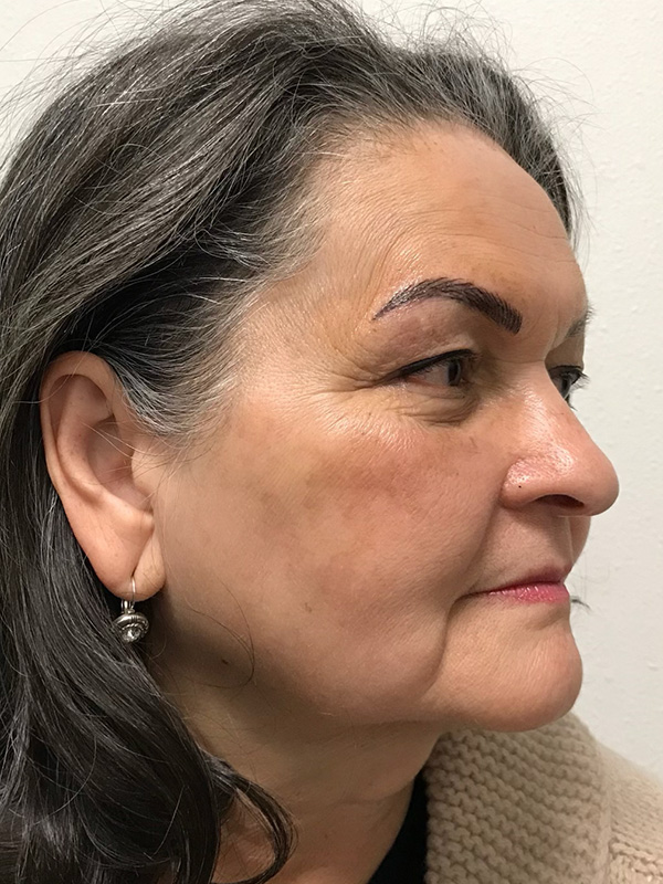Pico Laser Skin Rejuvenation Before & After Gallery - Patient 176657394 - Image 4