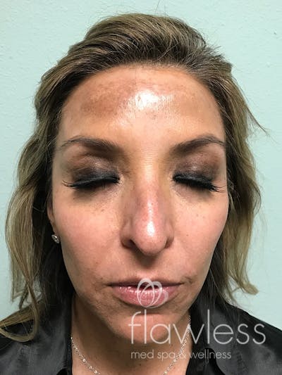 Pico Laser Skin Rejuvenation Before & After Gallery - Patient 176657396 - Image 1