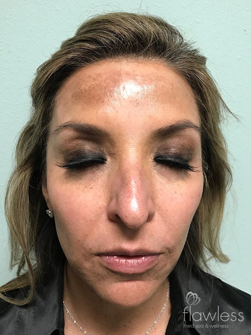 Pico Laser Skin Rejuvenation Before & After Gallery - Patient 176657396 - Image 1