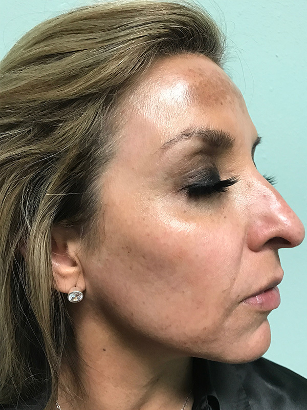 Pico Laser Skin Rejuvenation Before & After Gallery - Patient 176657396 - Image 3