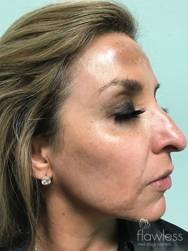 Pico Laser Skin Rejuvenation Before & After Gallery - Patient 176657396 - Image 3