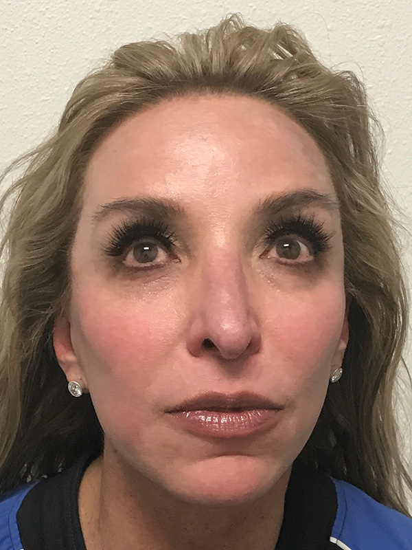 Pico Laser Skin Rejuvenation Before & After Gallery - Patient 176657396 - Image 2