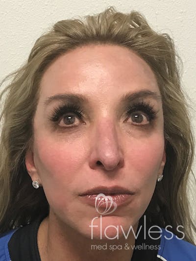 Pico Laser Skin Rejuvenation Before & After Gallery - Patient 176657396 - Image 2