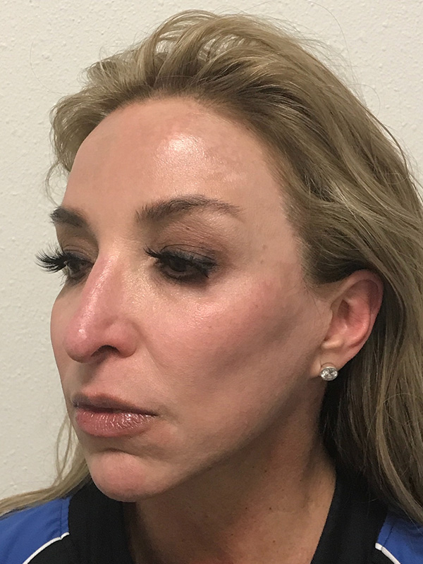 Pico Laser Skin Rejuvenation Before & After Gallery - Patient 176657396 - Image 6