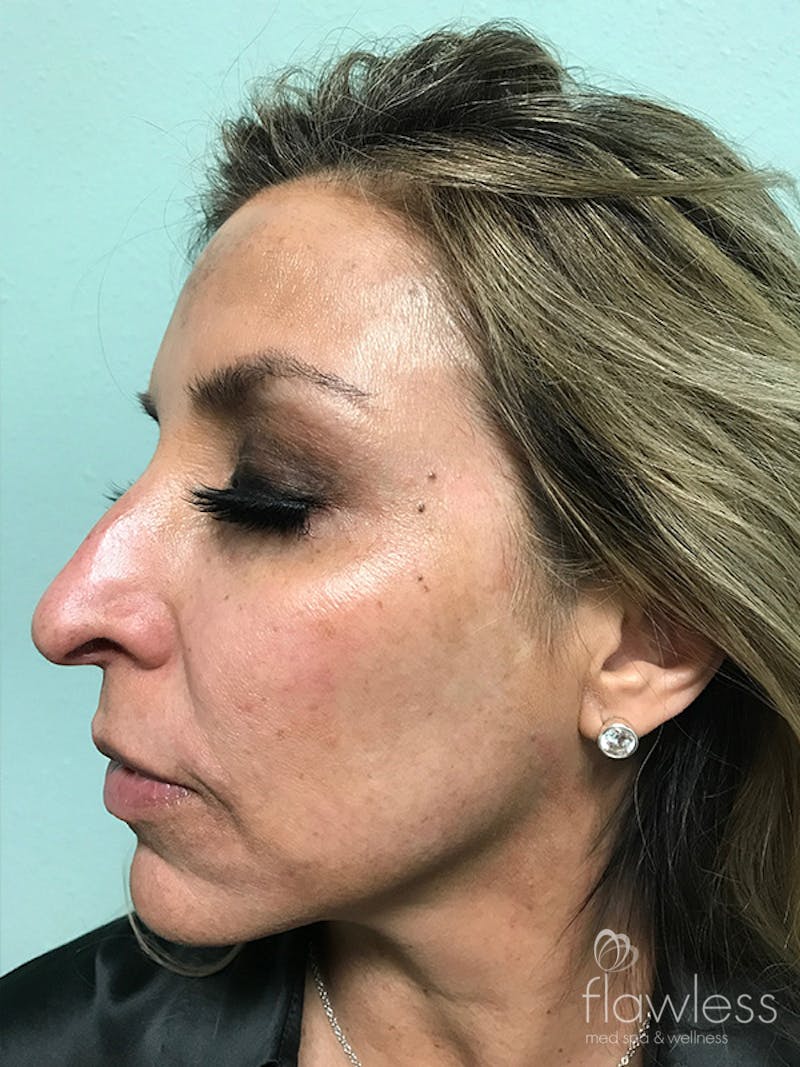 Pico Laser Skin Rejuvenation Before & After Gallery - Patient 176657396 - Image 5