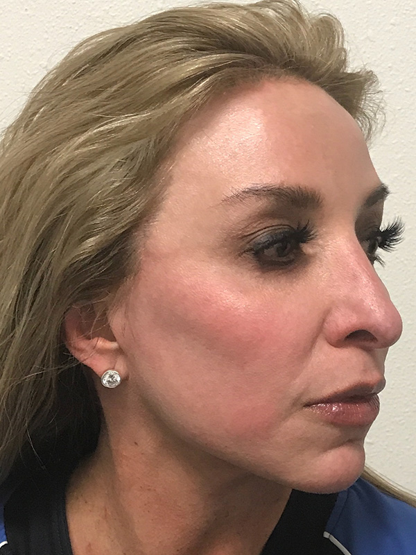 Pico Laser Skin Rejuvenation Before & After Gallery - Patient 176657396 - Image 4