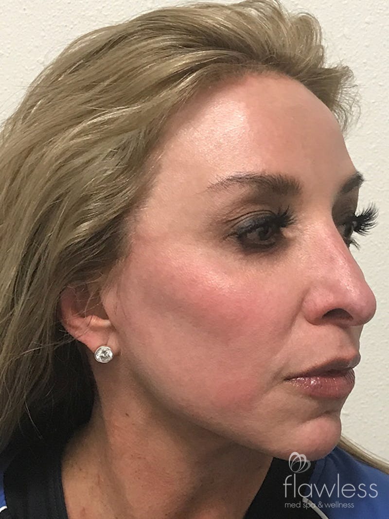 Pico Laser Skin Rejuvenation Before & After Gallery - Patient 176657396 - Image 4