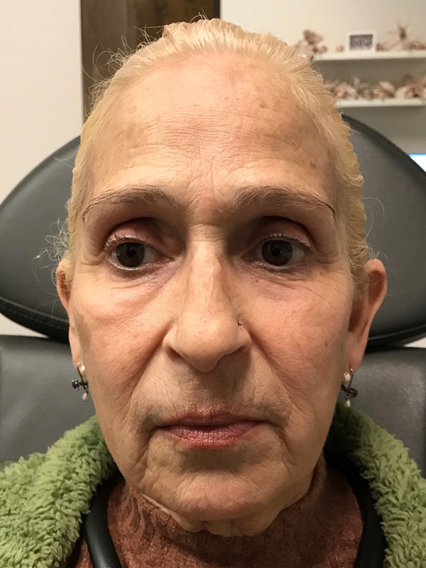 Pico Laser Skin Rejuvenation Before & After Gallery - Patient 176657395 - Image 1