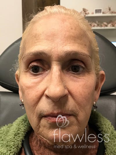 Pico Laser Skin Rejuvenation Before & After Gallery - Patient 176657395 - Image 1