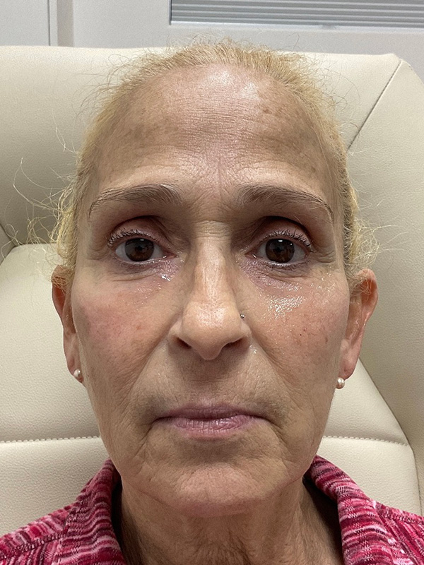 Pico Laser Skin Rejuvenation Before & After Gallery - Patient 176657395 - Image 2